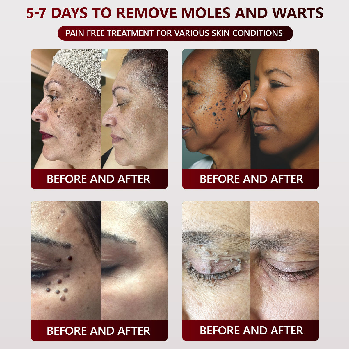 👑👑 SEAGRIL™ 𝐁𝐥𝗮𝐜𝐤 𝐑𝐢𝐜𝗲 𝐒𝐤𝗶𝐧 𝐑𝗲𝐩𝐚𝗶𝐫 𝐄𝐬𝐬𝗲𝐧𝐜𝐞 𝐂𝐫𝗲𝗮𝐦 ⚕️ 𝗠𝗛𝗥𝗔 𝗖𝗲𝗿𝘁𝗶𝗳𝗶𝗲𝗱 (𝗘𝗹𝗶𝗺𝗶𝗻𝗮𝘁𝗲𝘀 𝘄𝗮𝗿𝘁𝘀 𝗮𝗻𝗱 𝘀𝗸𝗶𝗻 𝘁𝗮𝗴𝘀, 𝗿𝗲𝗹𝗶𝗲𝘃𝗲𝘀 𝗽𝘀𝗼𝗿𝗶𝗮𝘀𝗶𝘀, 𝗶𝗺𝗽𝗿𝗼𝘃𝗲𝘀 𝗸𝗲𝗿𝗮𝘁𝗶𝗻 𝗯𝘂𝗶𝗹𝗱-𝘂𝗽 𝗮𝗻𝗱 𝗳𝗼𝗹𝗹𝗶𝗰𝘂𝗹𝗮𝗿 𝗸𝗲𝗿𝗮𝘁𝗶𝗻𝗶𝘇𝗮𝘁𝗶𝗼𝗻, 𝗳𝗮𝗱𝗲𝘀 𝗽𝗶𝗴𝗺𝗲𝗻𝘁𝗮𝘁𝗶𝗼𝗻, 𝘀𝘂𝗻 𝘀𝗽𝗼𝘁𝘀 & 𝗮𝗴𝗲 𝘀𝗽𝗼ts)