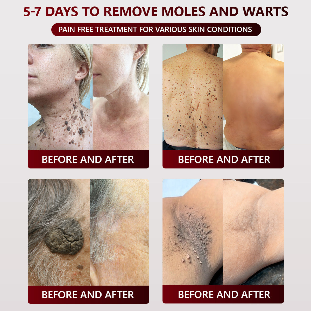 👑👑 SEAGRIL™ 𝐁𝐥𝗮𝐜𝐤 𝐑𝐢𝐜𝗲 𝐒𝐤𝗶𝐧 𝐑𝗲𝐩𝐚𝗶𝐫 𝐄𝐬𝐬𝗲𝐧𝐜𝐞 𝐂𝐫𝗲𝗮𝐦 ⚕️ 𝗠𝗛𝗥𝗔 𝗖𝗲𝗿𝘁𝗶𝗳𝗶𝗲𝗱 (𝗘𝗹𝗶𝗺𝗶𝗻𝗮𝘁𝗲𝘀 𝘄𝗮𝗿𝘁𝘀 𝗮𝗻𝗱 𝘀𝗸𝗶𝗻 𝘁𝗮𝗴𝘀, 𝗿𝗲𝗹𝗶𝗲𝘃𝗲𝘀 𝗽𝘀𝗼𝗿𝗶𝗮𝘀𝗶𝘀, 𝗶𝗺𝗽𝗿𝗼𝘃𝗲𝘀 𝗸𝗲𝗿𝗮𝘁𝗶𝗻 𝗯𝘂𝗶𝗹𝗱-𝘂𝗽 𝗮𝗻𝗱 𝗳𝗼𝗹𝗹𝗶𝗰𝘂𝗹𝗮𝗿 𝗸𝗲𝗿𝗮𝘁𝗶𝗻𝗶𝘇𝗮𝘁𝗶𝗼𝗻, 𝗳𝗮𝗱𝗲𝘀 𝗽𝗶𝗴𝗺𝗲𝗻𝘁𝗮𝘁𝗶𝗼𝗻, 𝘀𝘂𝗻 𝘀𝗽𝗼𝘁𝘀 & 𝗮𝗴𝗲 𝘀𝗽𝗼ts)